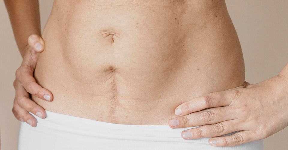 FISIOTERAPIA DE CICATRICES